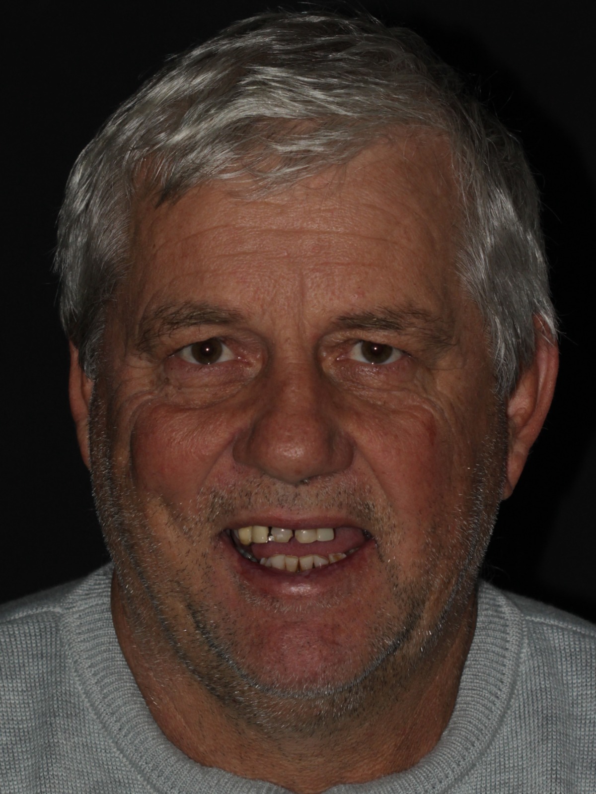 Caso 4 — antes do tratamento